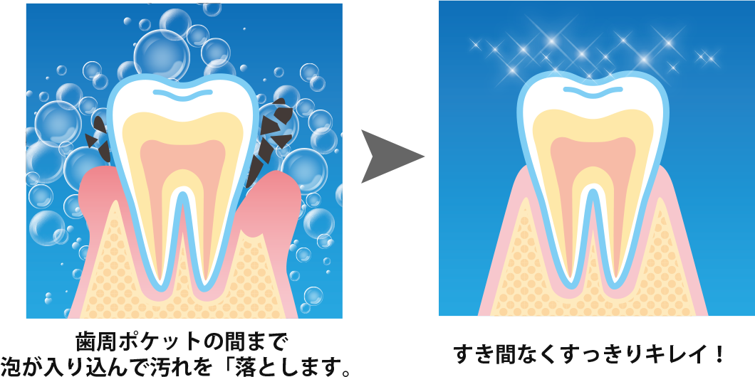 歯周ポケットの間まで泡が入り込んで汚れを「落とします。すき間なくすっきりキレイ!